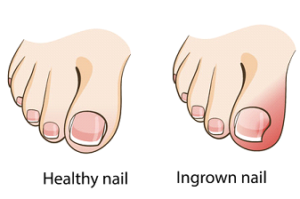 Ingrowntoenail